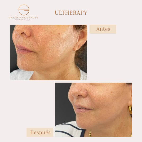 Ultherapy