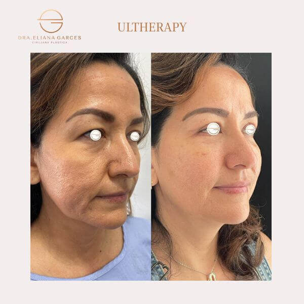 Ultherapy