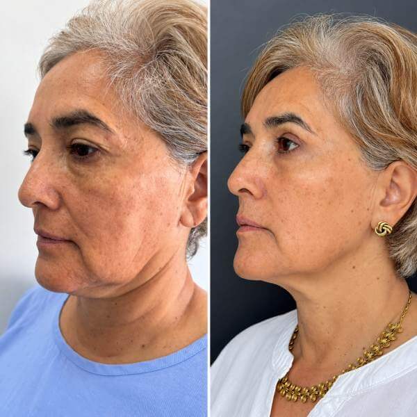 Blefaroplastia