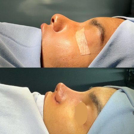 Nose Job
