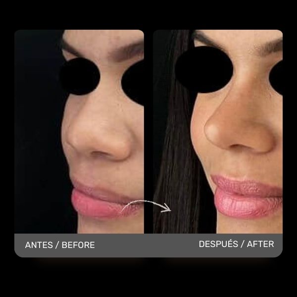 Nose Job