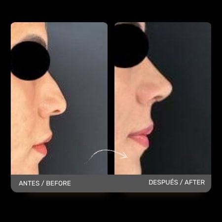 Nose Job