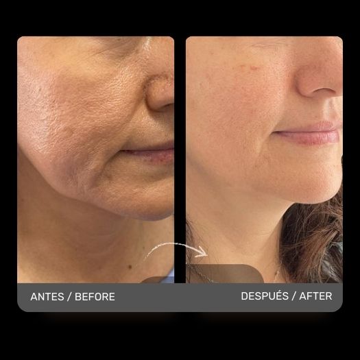 Non-Surgical chin correction