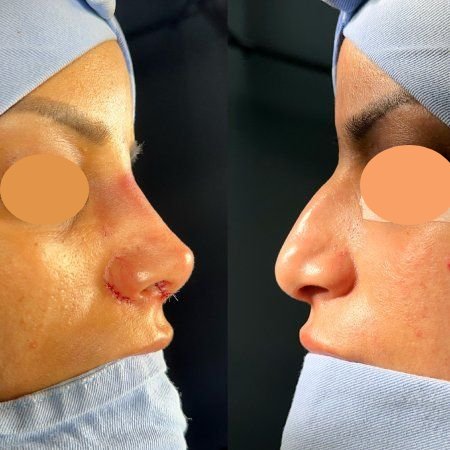 Nose Job