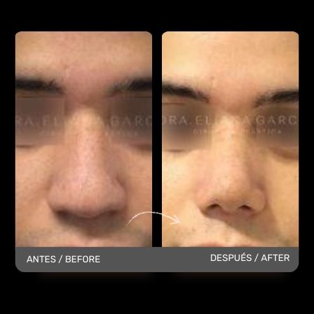 Masculine Nose Surgery