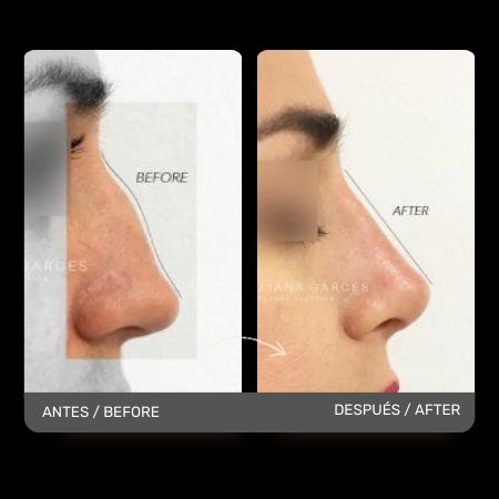 Nose Job