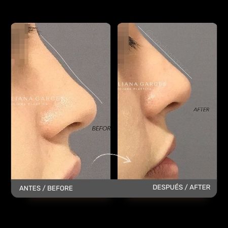 Non surgical nose job