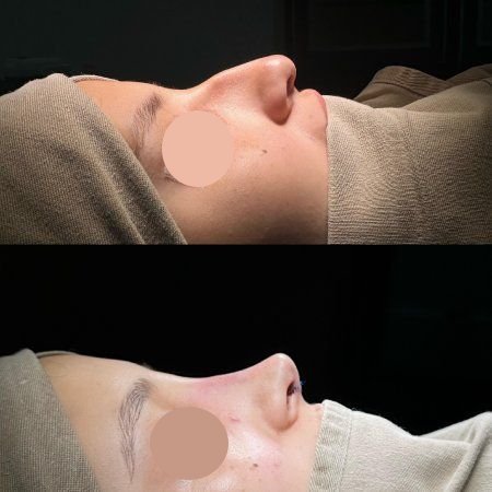 Nose Job