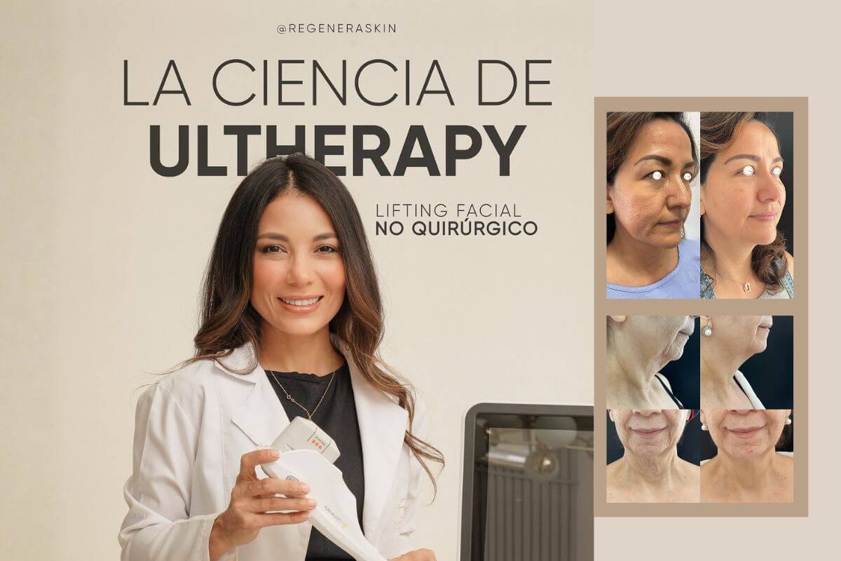 Collagen stimulation in Barranquilla: Ultherapy on face and neck with Dr. Eliana Garcés