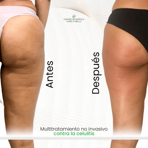 Celulitis