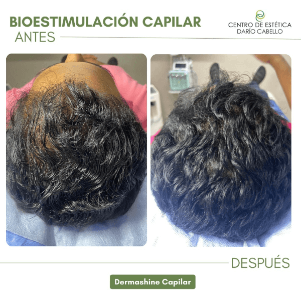 Alopecia