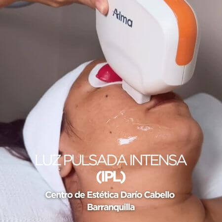 Luz Pulsada Intensa (IPL)