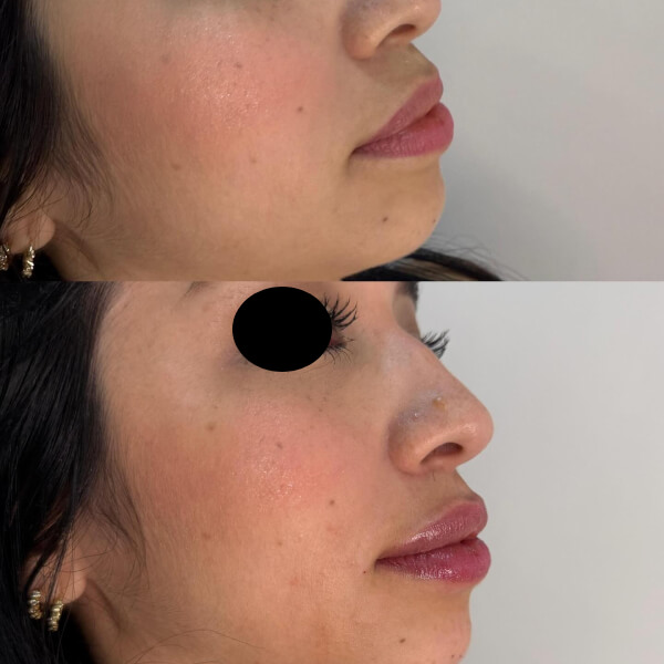 Aumento de labios