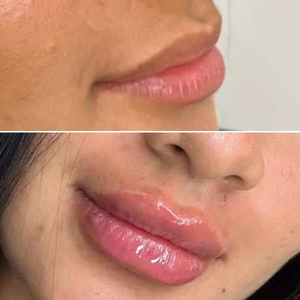 Aumento de labios