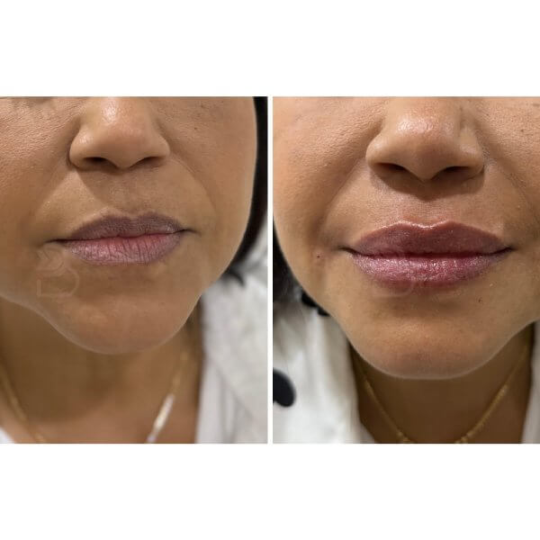 Aumento de labios