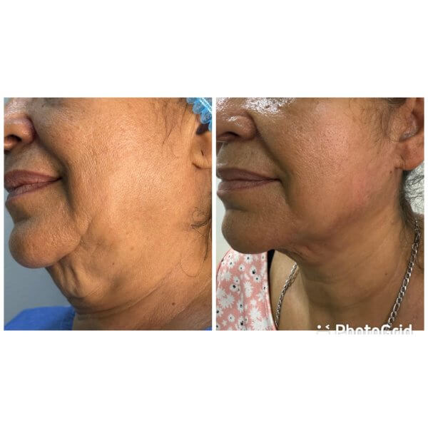 Rejuvenecimiento facial