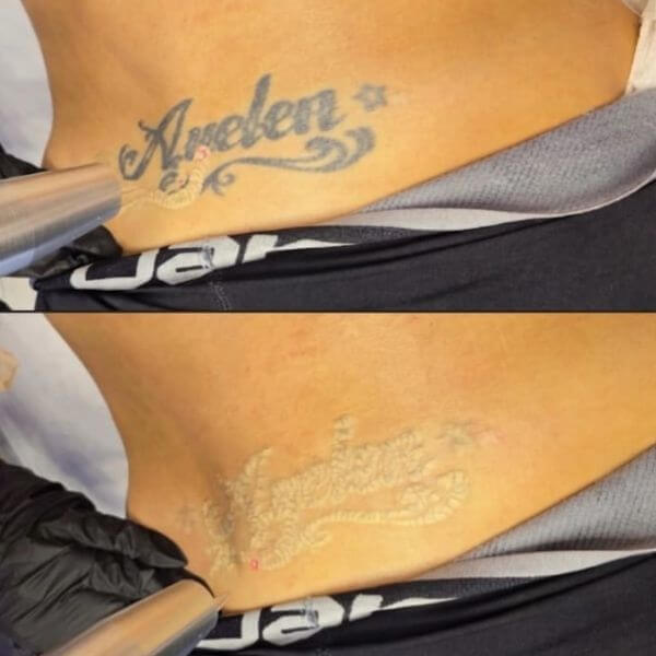 Tattoo removal