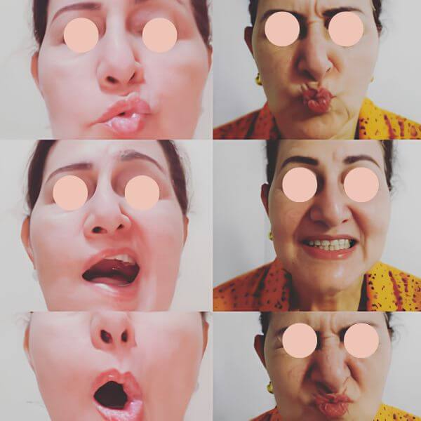 Physical therapy for facial paralysis