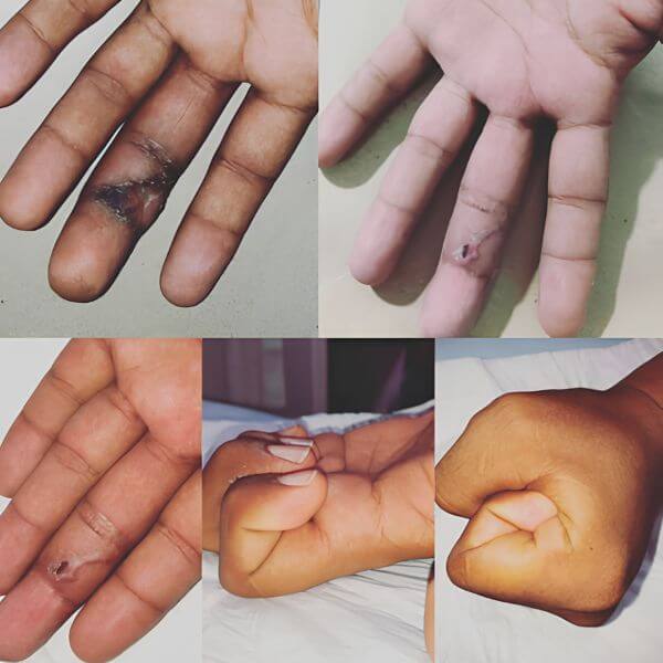 Hand physical therapy