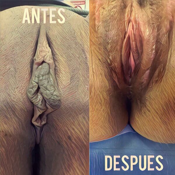Rejuvenecimiento vaginal