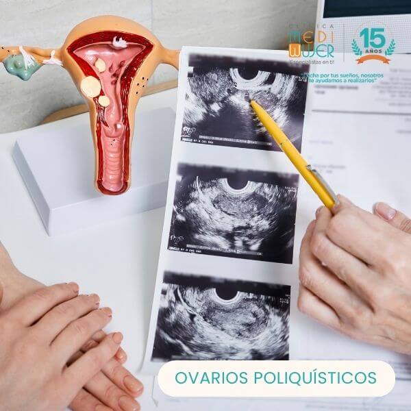  Polycystic ovaries