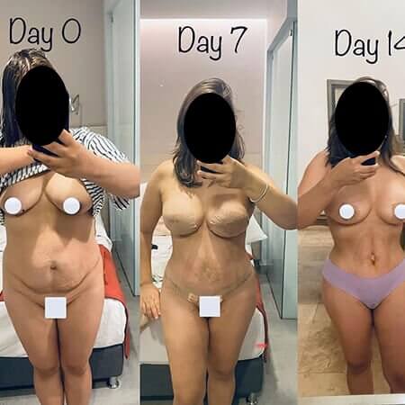 Mommy makeover