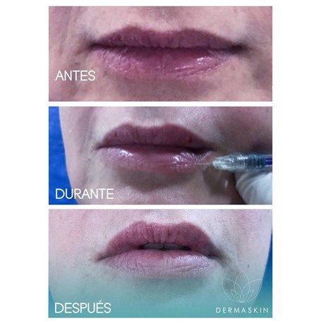 Aumento de labios