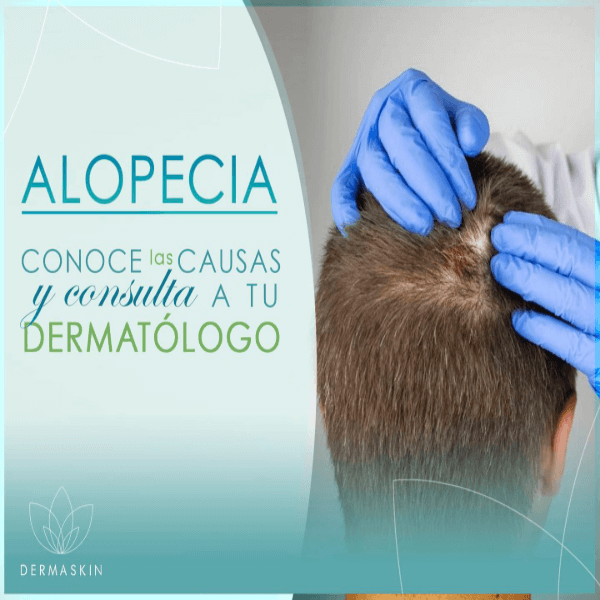 Alopecia