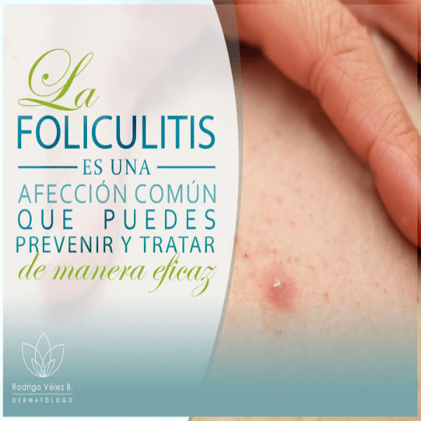 Foliculitis 