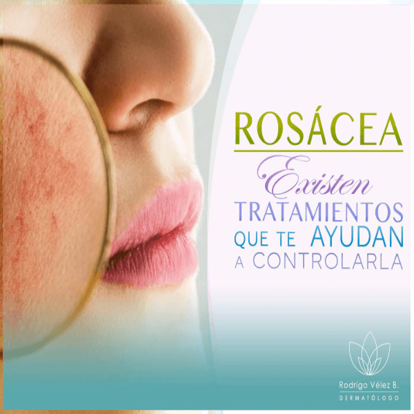 Rosácea