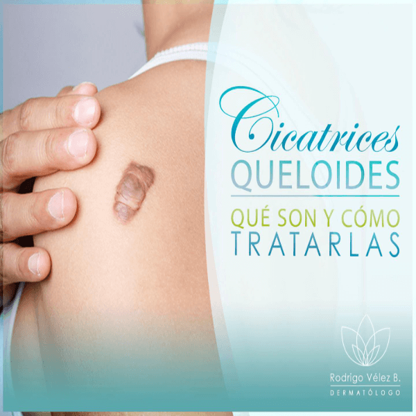 Tratamiento para cicatrices queloides
