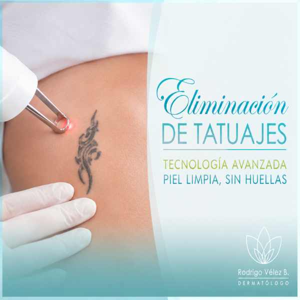 Eliminación de tatuajes