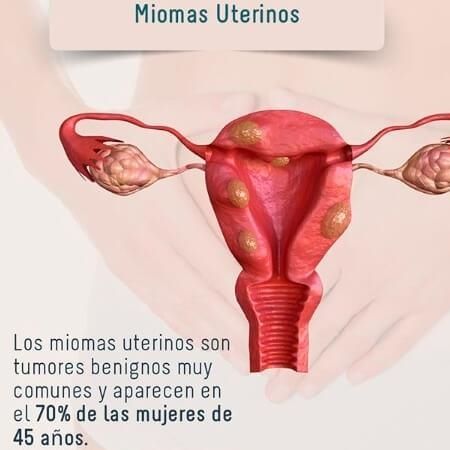 Miomas uterinos