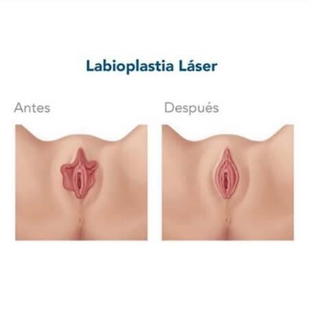 Labioplastia