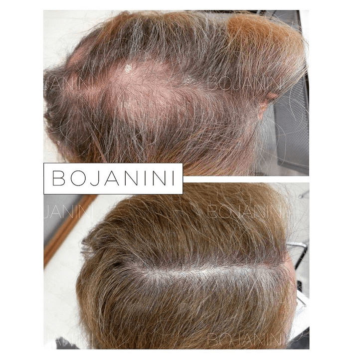 Alopecia