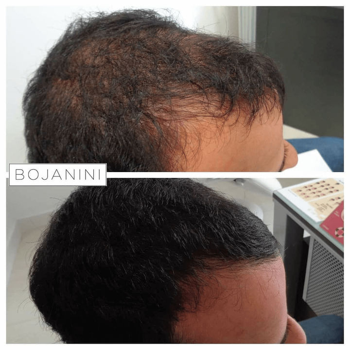 Alopecia