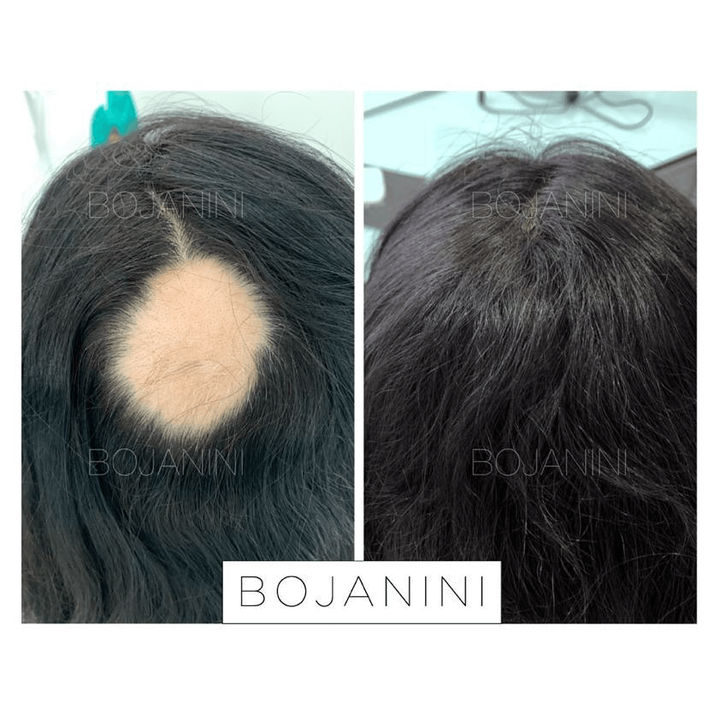 Alopecia