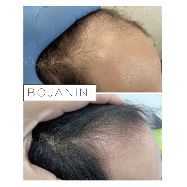 Alopecia