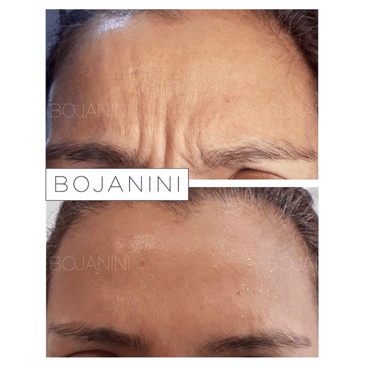 Botulinum toxin