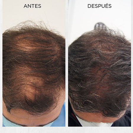 Alopecia