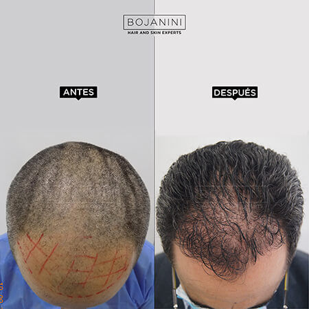 Hair Transplant