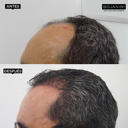 Hair Transplant