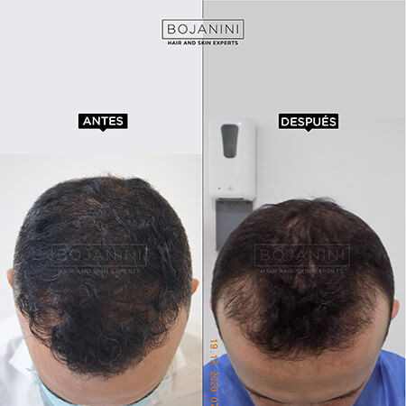 Hair Transplant
