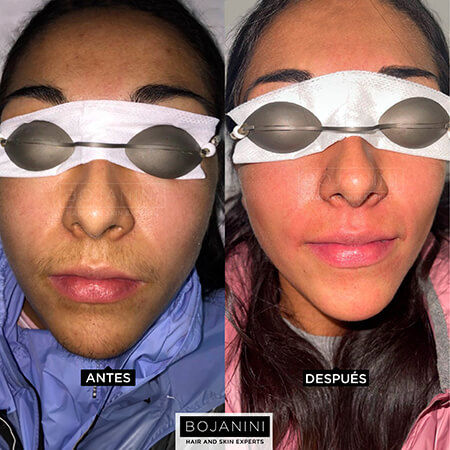 Laser hair removal
