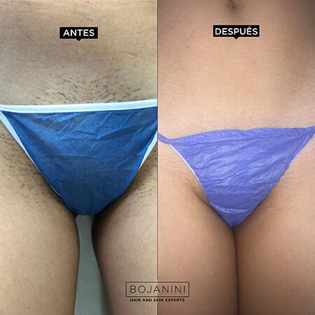 Laser hair removal