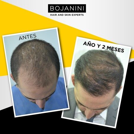 Hair Transplant
