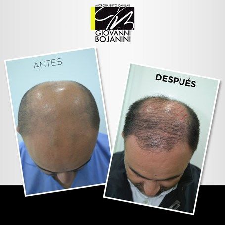 Hair Transplant