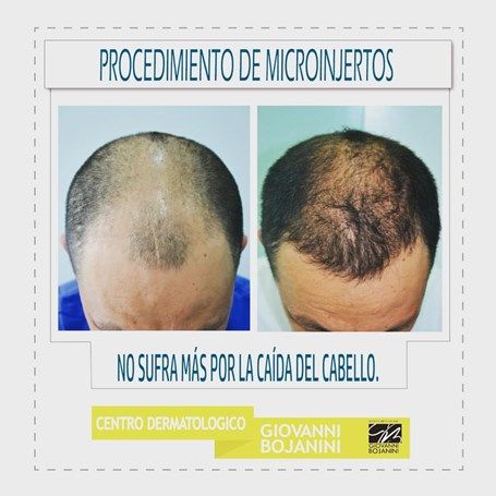 Hair Transplant