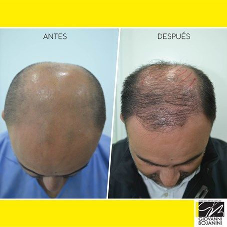 Hair Transplant