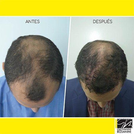Hair Transplant